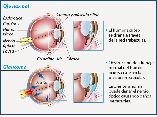 glaucomaquees.jpg2